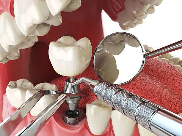 Best Dental Abscess Treatment in Baiting Hollow, NY